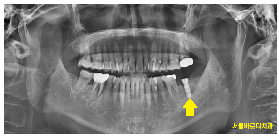 하남 미사 치과 공포증 치료가 두려우신 분들 컴온 관련 이미지 8