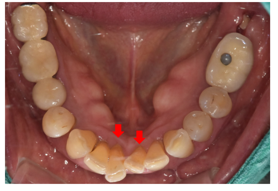 Restored 3 Teeth with Implants After Lower Front Teeth Became Loose and Fell Out image 2