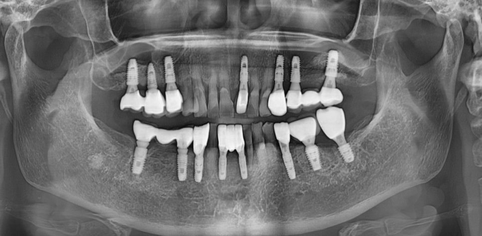 Restored 3 Teeth with Implants After Lower Front Teeth Became Loose and Fell Out image 9