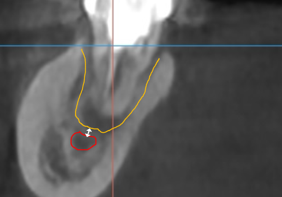 강동구 임플란트 기간, 사람마다 왜 다를까? 즉시식립과 지연식립의 결정적 차이 관련 이미지 7