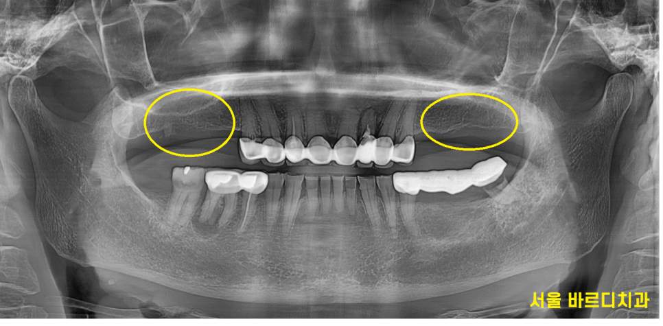 하남 임플란트 치과 주문진에서부터 치료 받으러 오신 환자분 관련 이미지 2