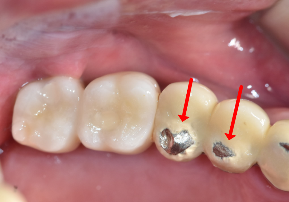 고덕 치과, 임플란트가 흔들려요. 뽑아야 할까 봐 고민이라면? 이렇게 해결합니다. 관련 이미지 11