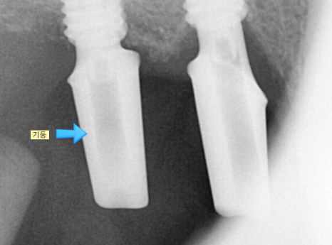 위아래 임플란트 동시에 하여 치료기간 단축하기 관련 이미지 7