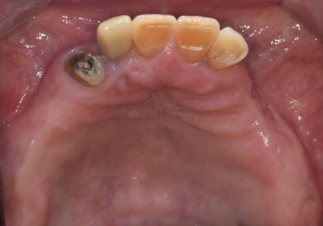 Cheonho Dental Clinic, Are You Over 65? We’re Revealing How to Reduce Denture and Implant Costs. image 5