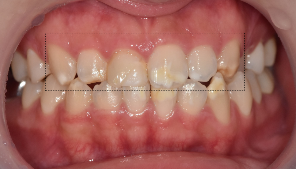 강동구 라미네이트, 치아 하얀 반점 없애고 싶다면? 치료 방법 관련 이미지 6