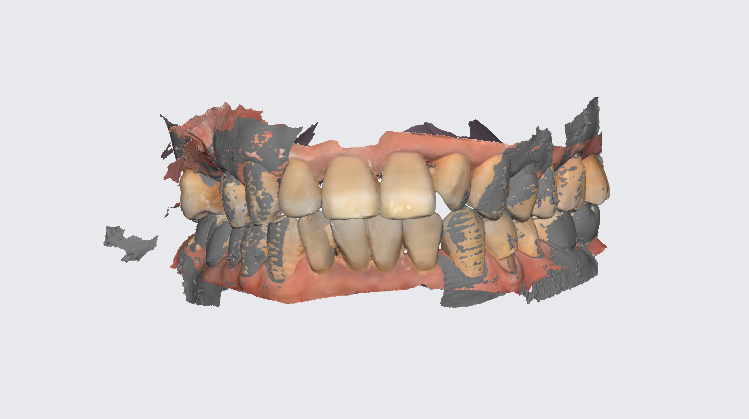 하남시청치과 신경치료 치아 발치 후 임플란트 했습니다. 관련 이미지 8