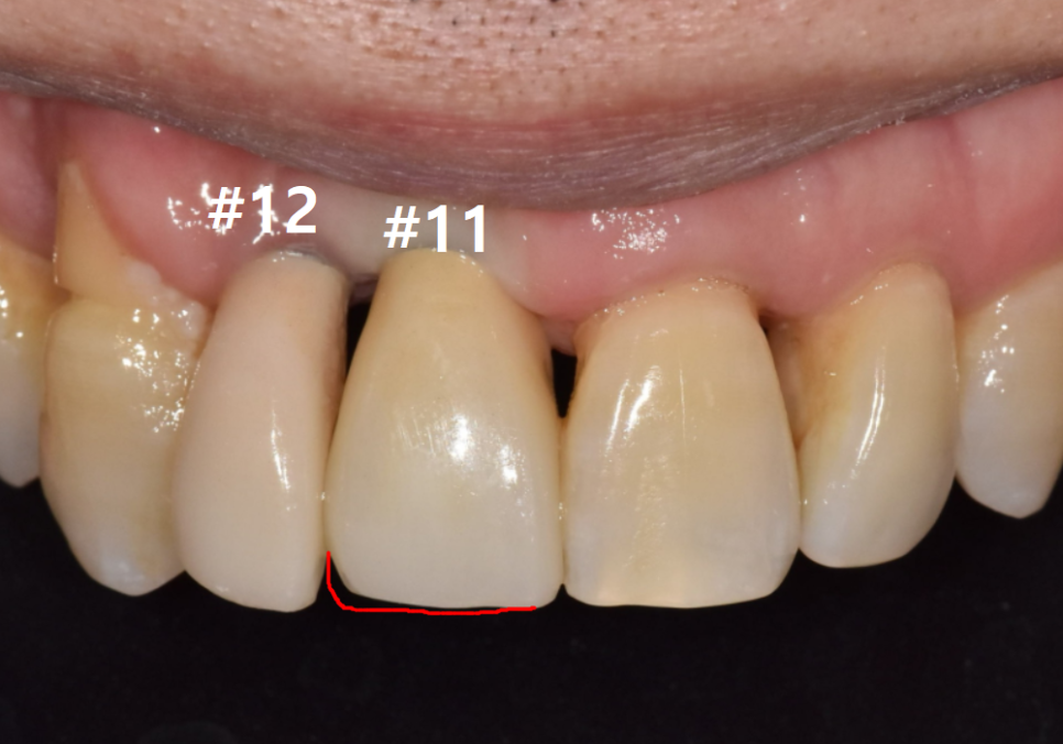 앞니 임플란트, 원내 기공소의 중요성을 아시나요? 관련 이미지 17