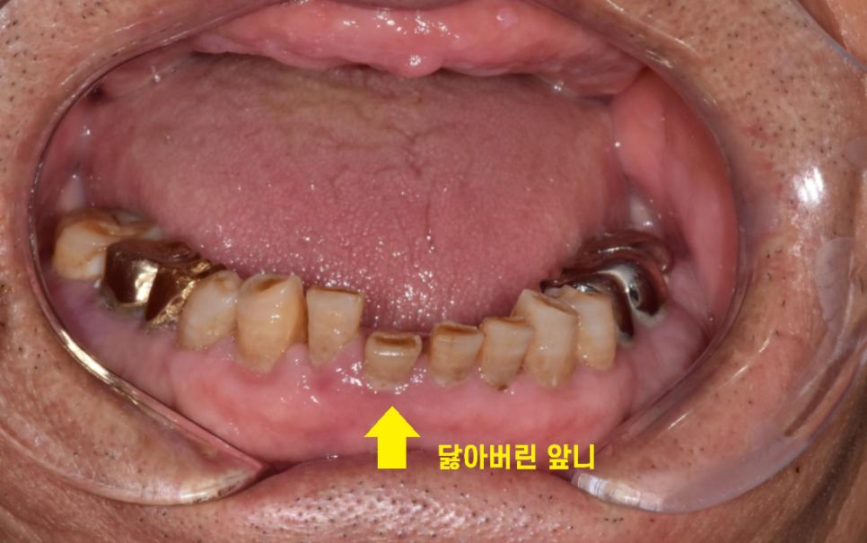 둔촌동 치과 80대 임플란트 가능한가요? 관련 이미지 4