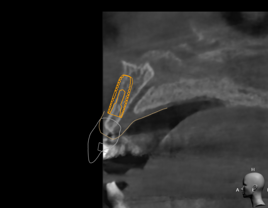 하남시청치과 디지털 임플란트를 고집하는 이유 관련 이미지 9