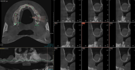 고덕역  치과 틀니쓰다 위아래 전악 임플란트 재건했습니다. 관련 이미지 5