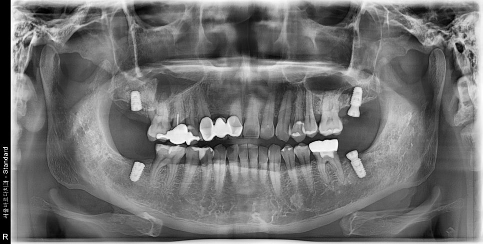 상일동치과 서울바르디치과 무절개 네비게이션 임플란트 치료증례 #7 관련 이미지 6
