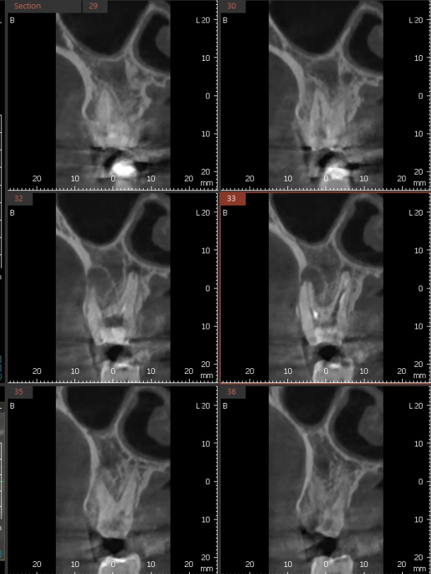 발치 대신 신경치료 뽑기 전 치료는 한번 해봐야하지않을까요? 관련 이미지 8