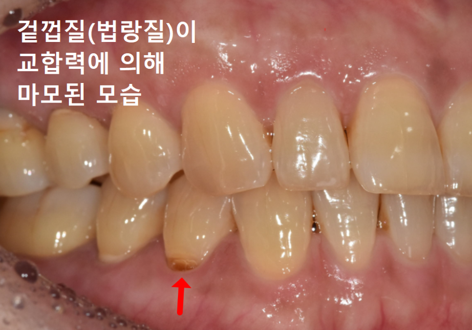 고덕역치과, 잇몸 패임(치경부 마모) 레진 치료, 왜 자꾸 떨어지나요? 관련 이미지 3