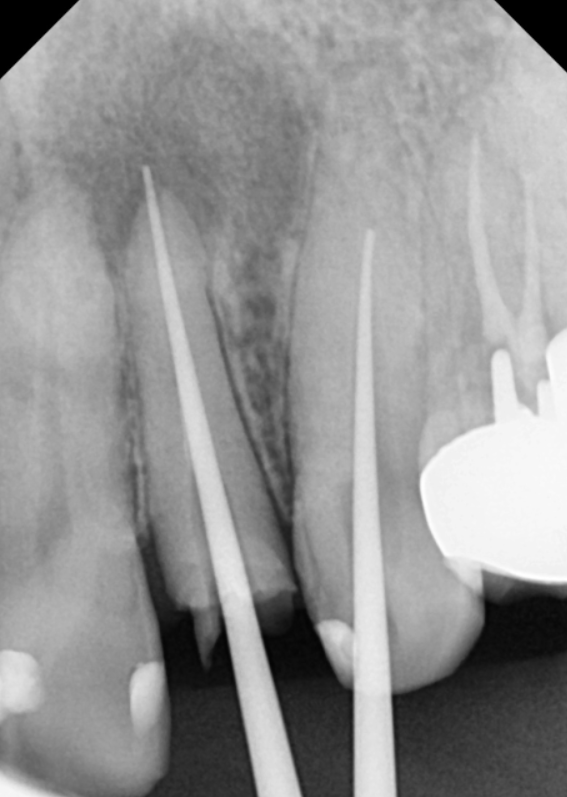 강동구 재신경치료, 왜 첫 치료보다 성공률이 낮다고 할까요? 관련 이미지 11