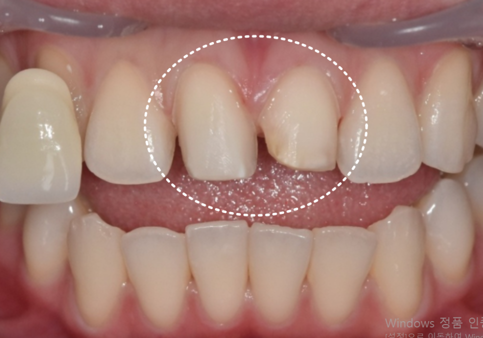 절단교합으로 인한 앞니 레진 깨짐, 교정 없이 해결한 사례 관련 이미지 8