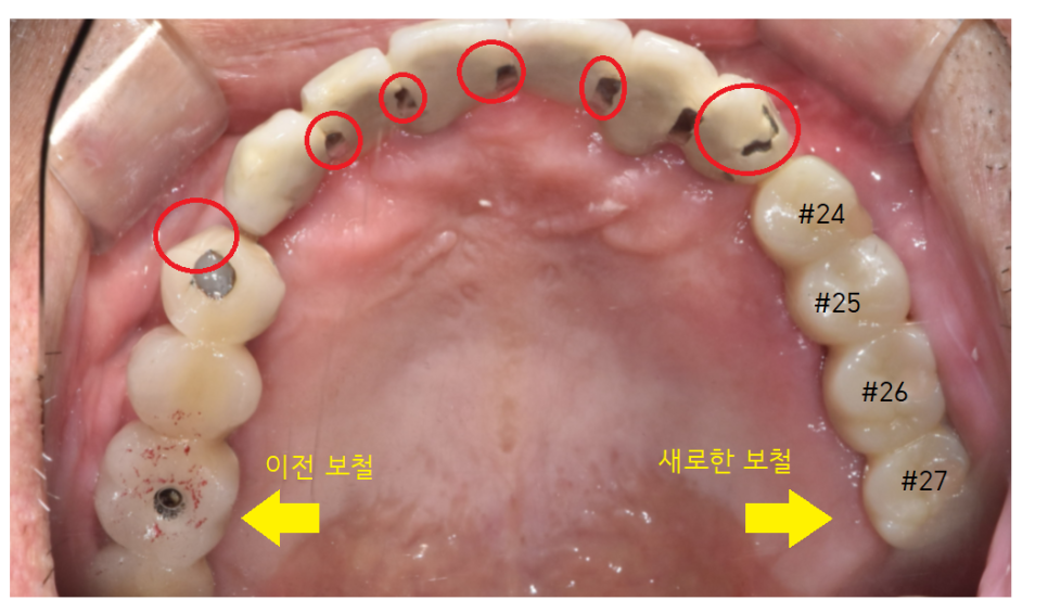 덕풍동 치과 오래된 임플란트 제거 후 재식립하였습니다. 관련 이미지 13