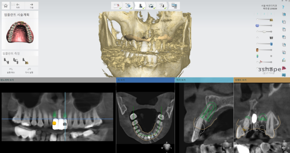 미사 임플란트 보철 새로하고 연결했습니다. 관련 이미지 6