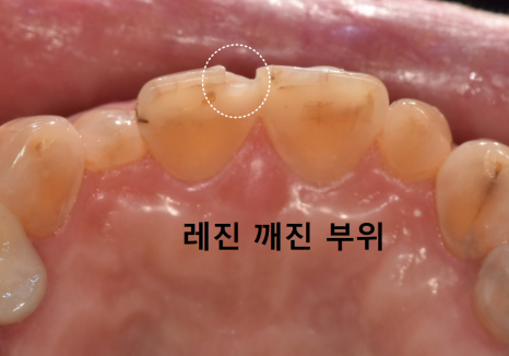 중장년 라미네이트, 70대도 가능한가요? 왜소치와 벌어진 앞니 해결 사례 관련 이미지 5