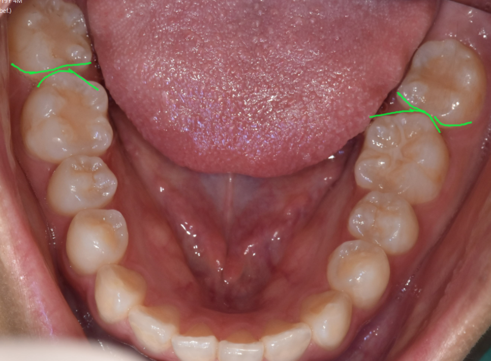 3 Ways to Fix Gaps Between the Front Teeth with Orthodontic Treatment image 4