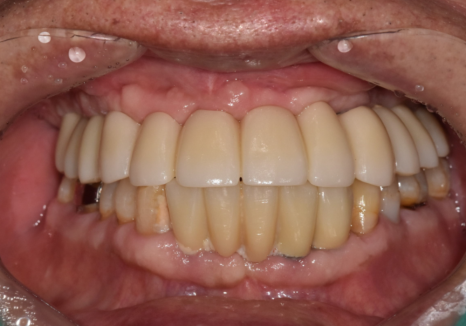 뼈가 없어서 안 된다구요? 70대 당뇨 무치악 환자분의 전체 임플란트 사례 관련 이미지 16