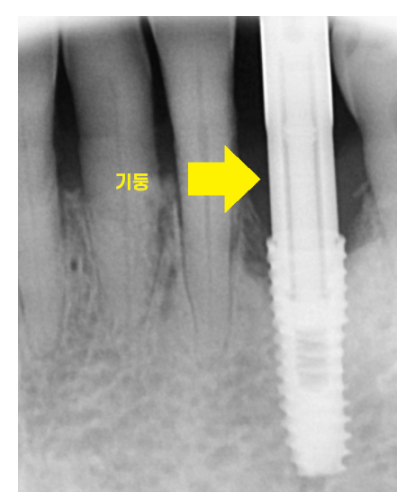 하루만에 임플란트 당일치기가 가능한 조건은?? 관련 이미지 6
