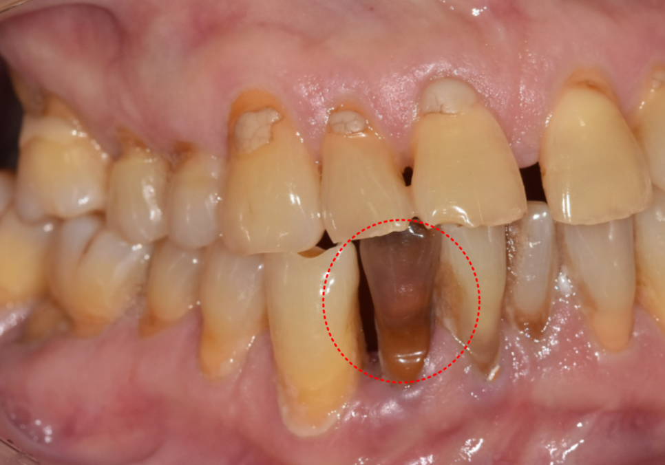 앞니 변색, 치아미백효과 없는 이유 솔직하게 말씀드립니다. 관련 이미지 2