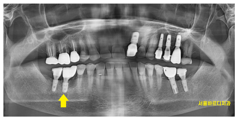 암사동 치과 치아 뿌리 균열 금 갔을 때 임플란트 치료로 행복해지세요. 관련 이미지 8