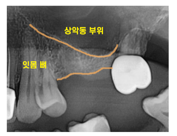 상일동역 치과 상악동 수술 후 코피 이렇게 대처하세요! 관련 이미지 3