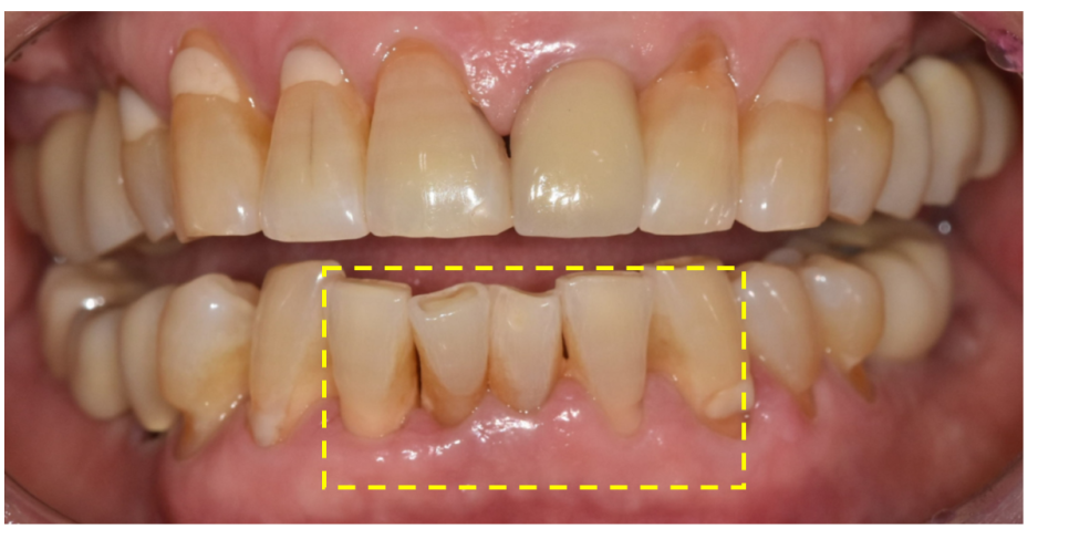 Restored 3 Teeth with Implants After Lower Front Teeth Became Loose and Fell Out image 1