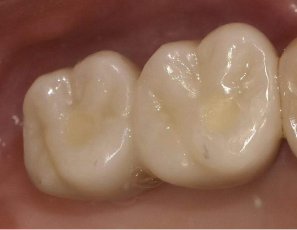 치아 뿌리 염증 빼야 된다는 치아, 이렇게 살렸습니다. 치료 방법 관련 이미지 9