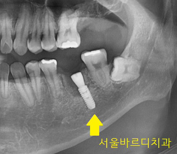 감일동 치과 첫번째 임플란트 시작이 중요합니다. 관련 이미지 8