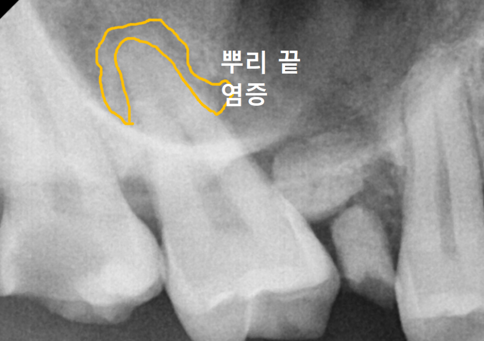 Myeongil-dong Implant Treatment in Your 20s: The Reason It Ended Up Requiring Bone Grafting After Thinking, “I’m Young, So It’ll Be Fine” image 6