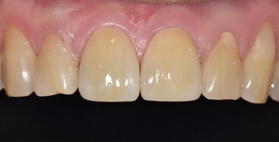앞니 금 갔을 때, 방치하면 안 되는 진짜 이유 <파절 치료 사례> 관련 이미지 12