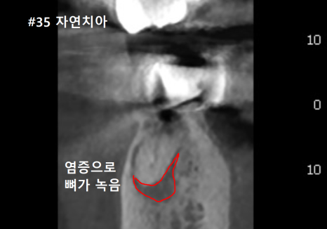 상일역 임플란트, 음식물 끼는 이유, 처음엔 안 그랬는데 왜 점점 심해지는 걸까요? 관련 이미지 9