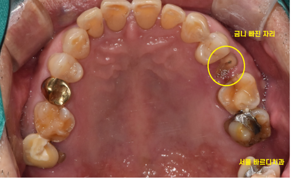 미사 임플란트 금니 빠짐 보철물 빠졌을 때 대처법 알려드려요 관련 이미지 3