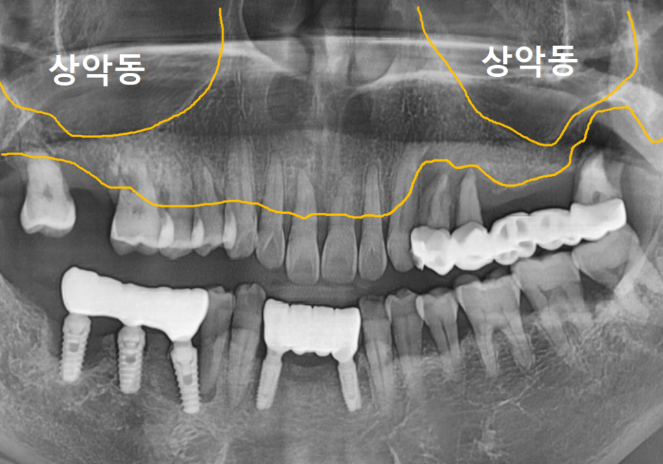 편측 저작, 한쪽으로만 식사하면 결국 이렇게 됩니다. 관련 이미지 10