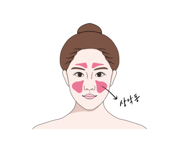 미사 임플란트 상악동 거상술 제일 어렵고 난이도가 높습니다. 관련 이미지 2