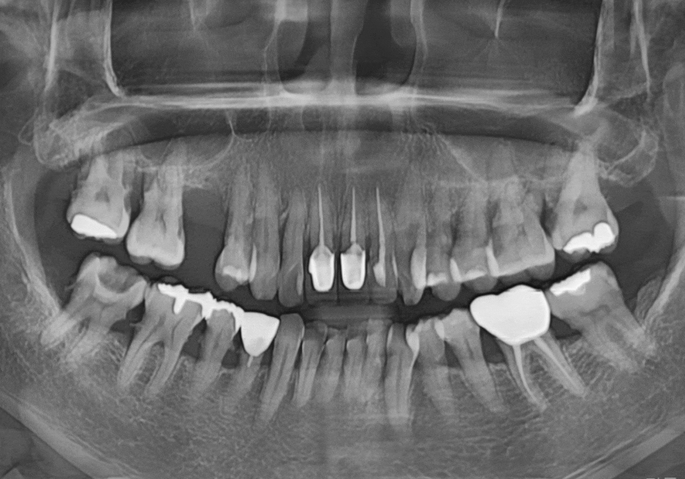 고덕동 스케일링 미루다 앞니 어금니 다 뽑고 임플란트 했습니다. 관련 이미지 9