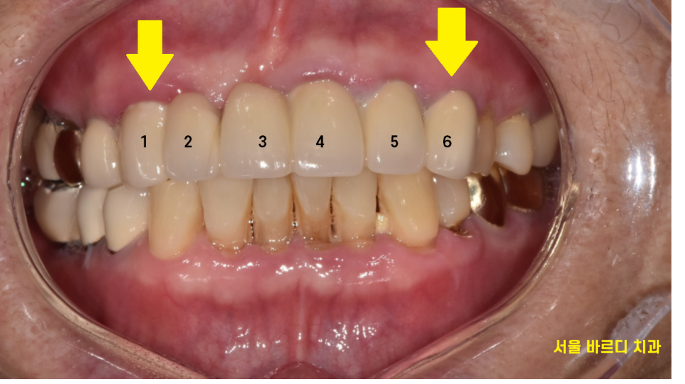 하남미사치과 앞니 브릿지를 임플란트로 교체했습니다. 관련 이미지 3