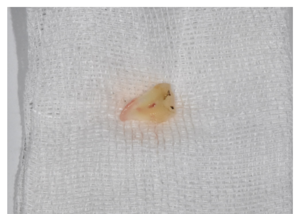 금간 치아 통증 심할 때 발치와 임플란트가 필요한 이유 관련 이미지 4