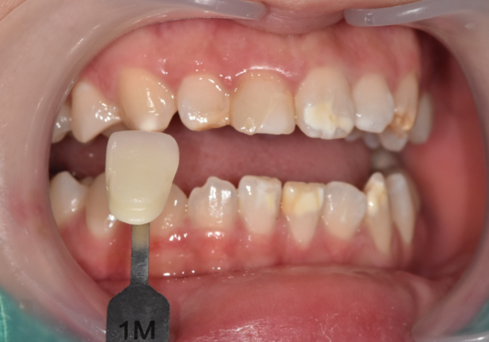 고덕역 치과 반점치 얼룩덜룩한 치아, 치료 실패 줄이는 5가지 기준 관련 이미지 8