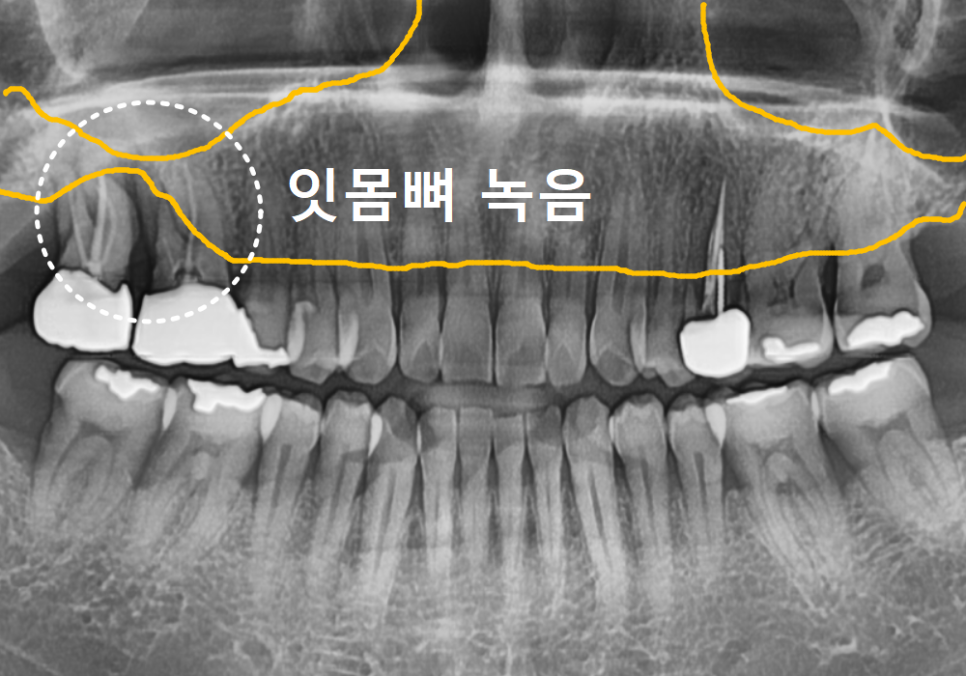 강동구 잇몸 퇴축으로 뿌리 드러난 치아, 이대로 둬도 괜찮을까? 관련 이미지 8