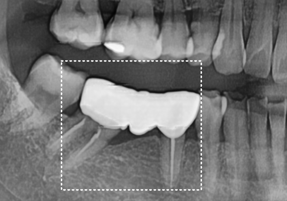 발치 후 빈 공간, 이 빼고 오래 냅두면 이렇게 됩니다. 관련 이미지 8