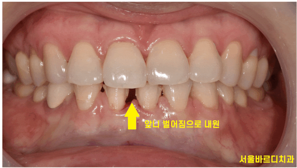 고덕동 치과에서 시행한 라미네이트와 치아 미백 과정 및 순서 관련 이미지 1