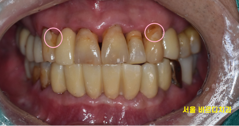 녹아버린 잇몸뼈 흔들리는 여러 치아 발치 후 임플란트 시행 관련 이미지 10