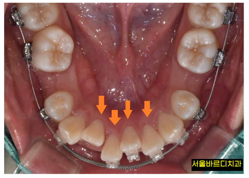 성인 치아교정 기간 평균 2년이 소요되는 까닭은? 관련 이미지 4