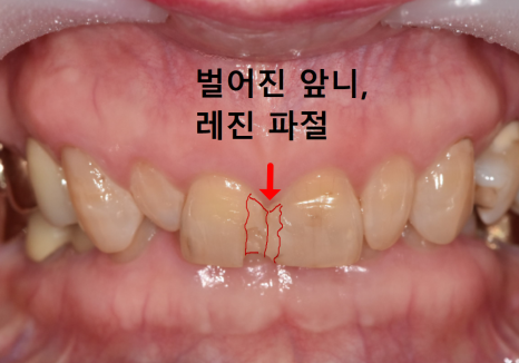 중장년 라미네이트, 70대도 가능한가요? 왜소치와 벌어진 앞니 해결 사례 관련 이미지 4