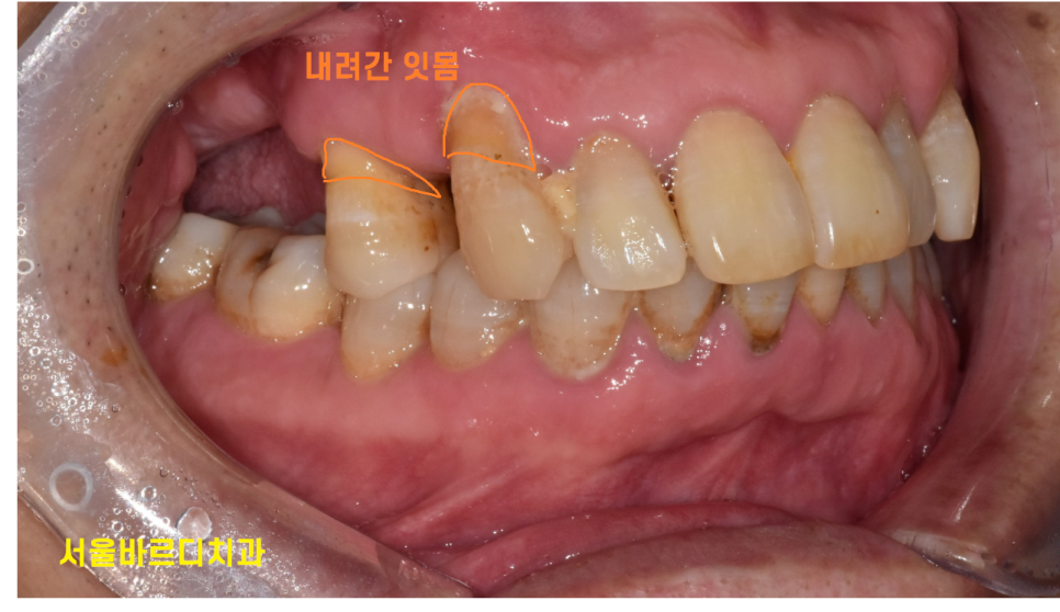 음식물 끼임 생겼다고 이쑤시개 쓰면 안되는 이유 관련 이미지 3