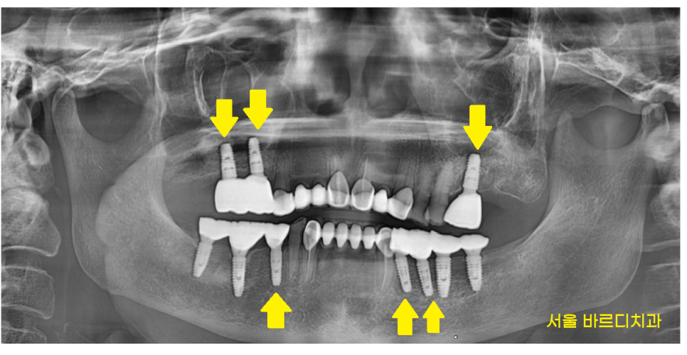 명일동 치과 임플란트 치료 기간 얼마나 걸릴까요??? 관련 이미지 8