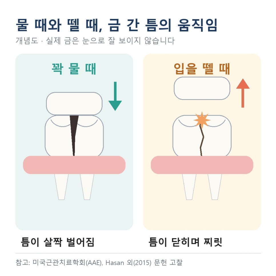 고덕동치과 치아 금 증상, 씹을 때보다 뗄 때 찌릿하면 의심해 보세요 관련 이미지 4